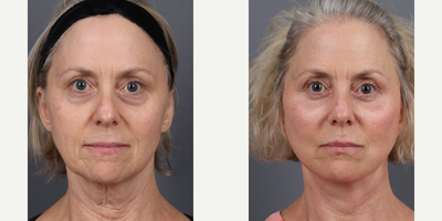 Case 9241 - Woman treated with Deep Plane Facelift, Neck Lift, Eyelid Surgery, Facial Fat Transfer