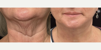 Case 9242 - 61 year old woman treated with Deep Plane Facelift, Neck Lift