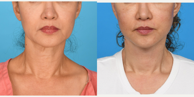 Case 9243 - 45-54 year old woman treated with Facelift, Neck Lift, Mini Facelift