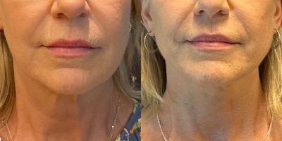 Case 9245 - Woman treated with Neck Lift