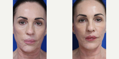 Case 9246 - Woman treated with Facelift, Neck Lift
