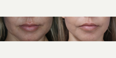 Case 9247 - Woman treated with Facelift, Neck Lift