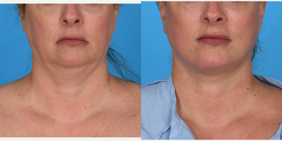 Case 9249 - 35-44 year old woman treated with Facelift, Neck Lift