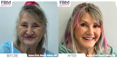 Case 9250 - 65-74 year old woman treated with Deep Plane Facelift, Neck Lift, Double Eyelid Surgery, Lip Lift, Rhinoplasty, Facial Fat Trans