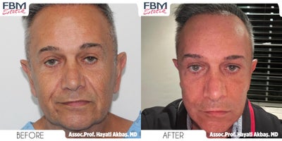 Case 9251 - 55-64 year old man treated with Deep Plane Facelift, Neck Lift, Eyelid Surgery, Facial Fat Transfer