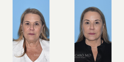 Case 9252 - Woman treated with Neck Lift