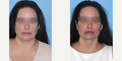 Case 9253 - Woman treated with Neck Lift