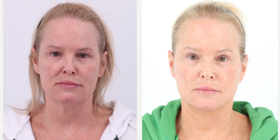 Case 9254 - 45-54 year old woman treated with Facelift, Neck Lift, Eyelid Surgery, Facial Fat Transfer, CO2 Laser