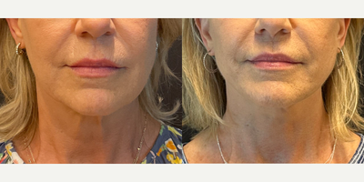 Case 9255 - Woman treated with Neck Lift