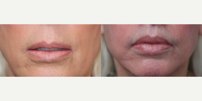 Case 9257 - 65-74 year old woman treated with Facelift, Neck Lift, Lip Lift