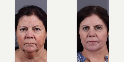 Case 9260 - Woman treated with Neck Lift