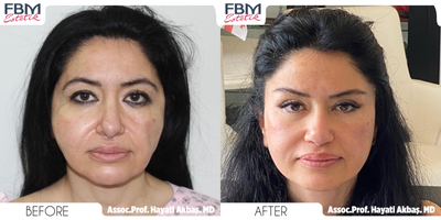 Case 9264 - 45-54 year old woman treated with Deep Plane Facelift, Neck Lift, Eyelid Surgery, Cheek Lift, Facial Fat Transfer, Canthoplasty