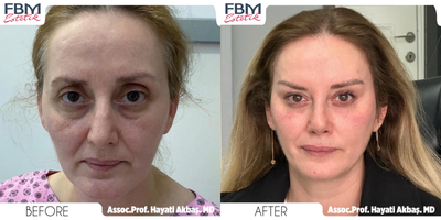 Case 9266 - 45-54 year old woman treated with Deep Plane Facelift, Neck Lift, Eyelid Surgery, Facial Fat Transfer