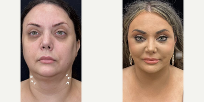 Case 9270 - Woman treated with Deep Plane Facelift, Neck Lift, Buccal Fat Removal, Facial Fat Transfer