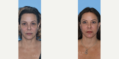 Case 9271 - 47 year old woman treated with Neck Lift