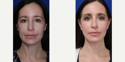 Case 9272 - Woman treated with Facelift, Neck Lift, CO2 Laser