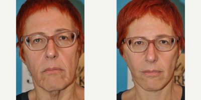 Case 9273 - Woman treated with Neck Lift