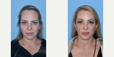 Case 9277 - 46 year old woman treated with Neck Lift