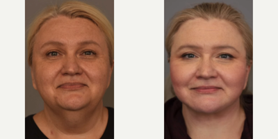 Case 9283 - Woman treated with Neck Lift