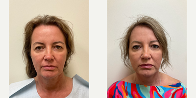 Case 9285 - Woman treated with Neck Lift