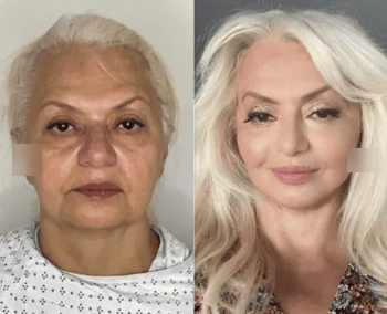 Case 9287 - 62 year old woman treated with Neck Lift, CO2 Laser