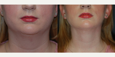 Case 9290 - Woman treated with Facelift, Neck Lift