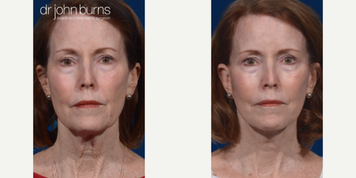 Case 9292 - Woman treated with Neck Lift