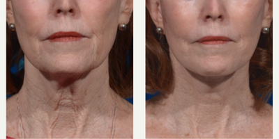 Case 9293 - Woman treated with Neck Lift