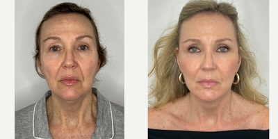 Case 9294 - 55-64 year old woman treated with Facelift, Neck Lift, Eyelid Surgery, Facial Fat Transfer, CO2 Laser