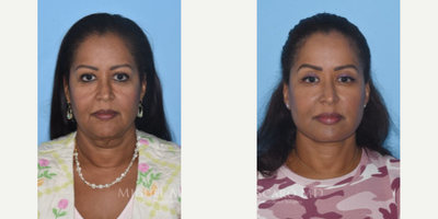 Case 9296 - Woman treated with Neck Lift