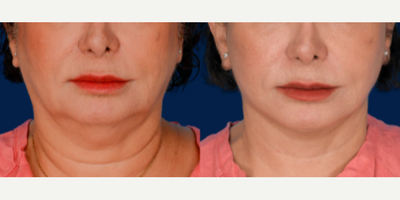 Case 9301 - Woman treated with Neck Lift