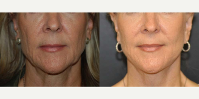 Case 9305 - 58 year old woman treated with Facelift, Neck Lift