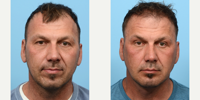 Case 9306 - 45-54 year old man treated with Neck Lift, Chin Implant