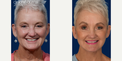 Case 9309 - Woman treated with Neck Lift