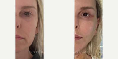 Case 9310 - Woman treated with Neck Lift