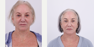 Case 9311 - 65-74 year old woman treated with Facelift, Neck Lift, Facial Fat Transfer, CO2 Laser
