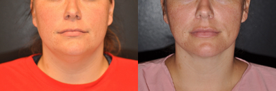 Case 9312 - Woman treated with Neck Lift