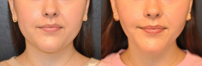 Case 9313 - Woman treated with Neck Lift