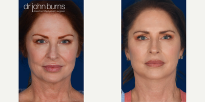 Case 9314 - Woman treated with Neck Lift