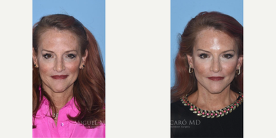 Case 9316 - Woman treated with Neck Lift