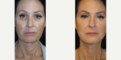 Case 9317 - Woman treated with Facelift, Neck Lift