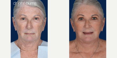 Case 9319 - Woman treated with Neck Lift