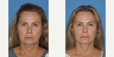 Case 9321 - 55-64 year old woman treated with Facelift, Neck Lift