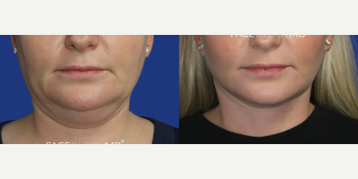 Case 9323 - Woman treated with Neck Lift, Facelift