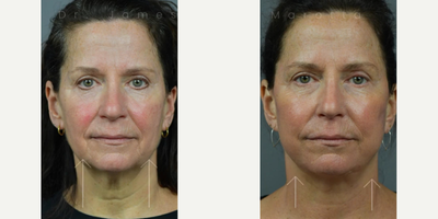 Case 9324 - Woman treated with Facelift