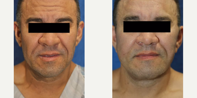 Case 9325 - 35-44 year old man treated with Brow Lift, Neck Lift, Facelift