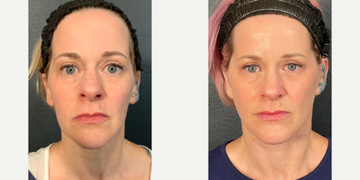 Case 9326 - Woman treated with Facelift, Neck Lift