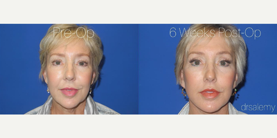 Case 9327 - Woman treated with Facelift, Neck Lift