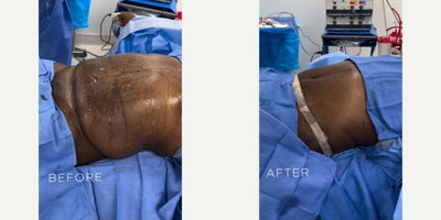 Case 933 - Man in his mid 50s treated with Tummy Tuck
