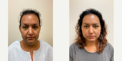 Case 9335 - Woman treated with Neck Lift